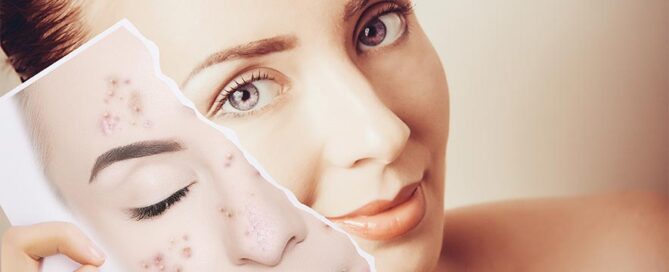 IPL Photo Facial Service in Orland Park