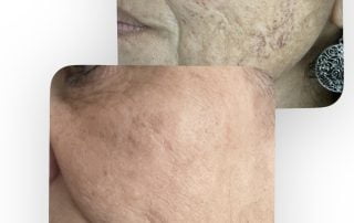 IPL Photofacial in Orland Park