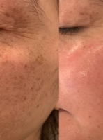 IPL Photofacial orland park