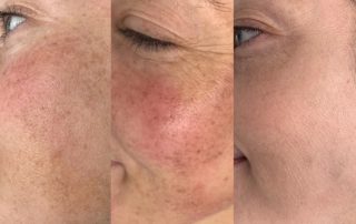IPL photofacial before and after in orland park il