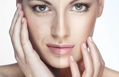 laser skin resurfacing costs