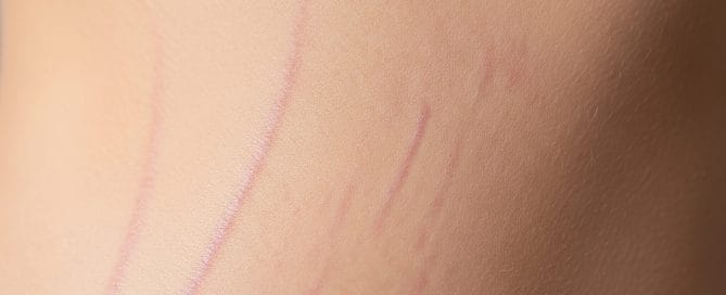 Stretch Mark Treatment