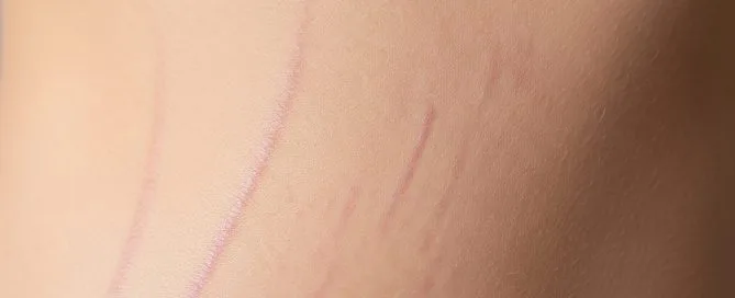 Stretch Mark Treatment