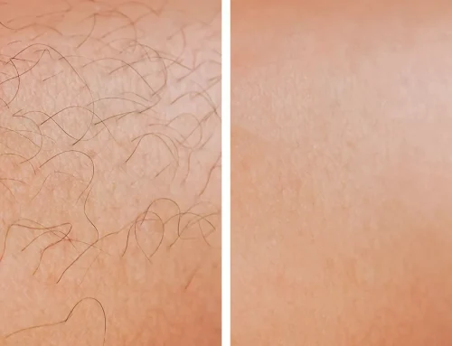 Laser Hair Removal in Tinley Park: Smooth, Hair-Free Skin